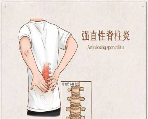 宫颈卵泡囊肿需要治疗吗