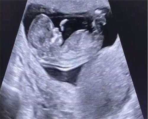 单身试管代生-早孕后几周确认宫内